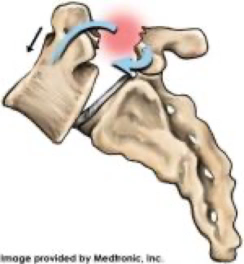 pars defect