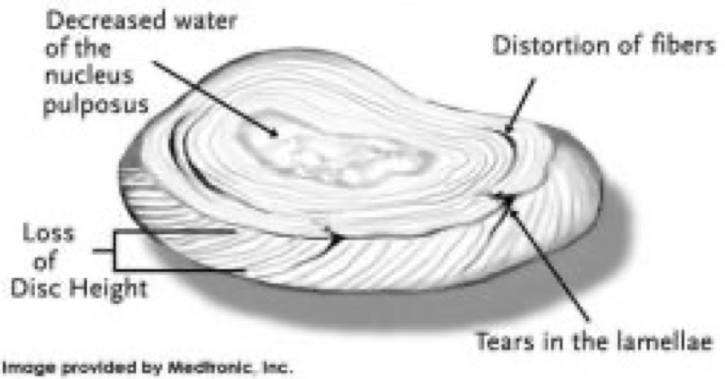 disc with mico-tear