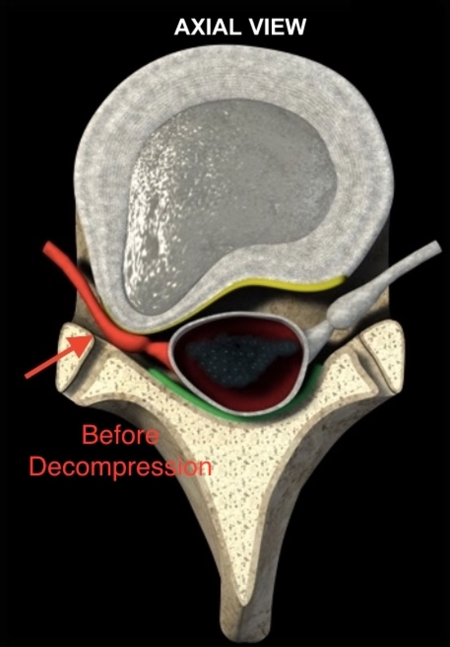 Disc bulge before decompression