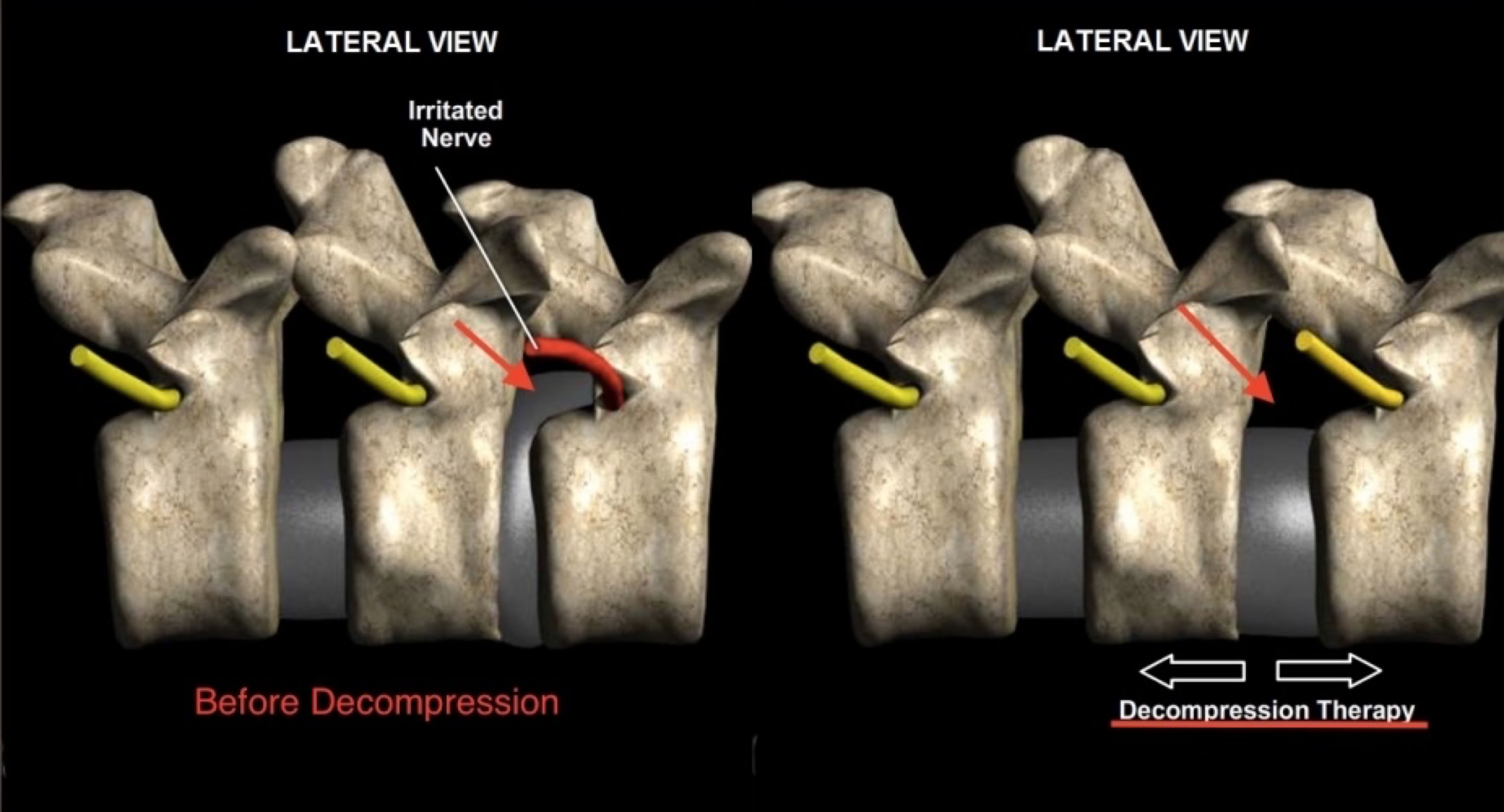 Before and after non-surgical spinal decompression